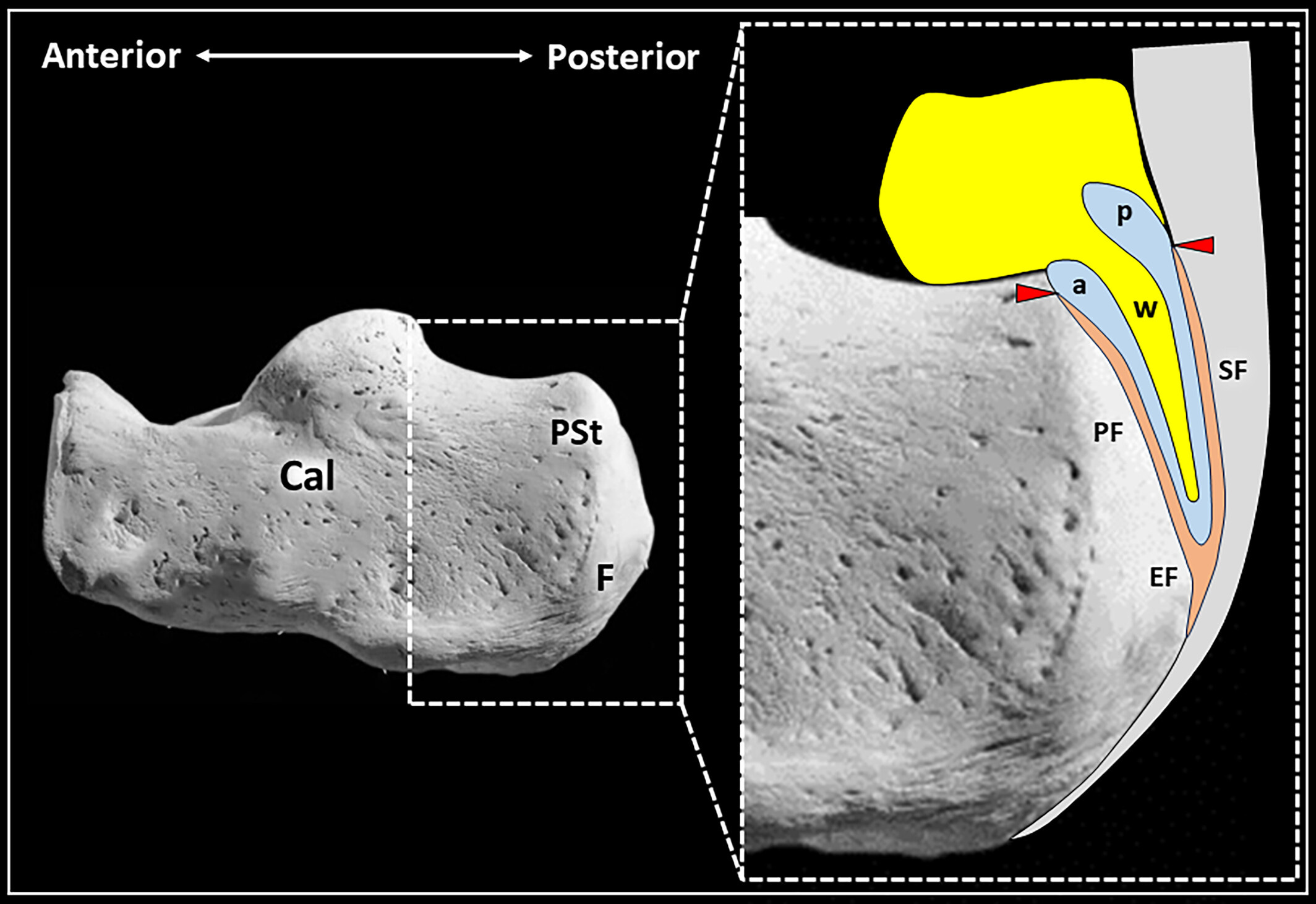 Bursa retrocalcanea 3 Tempo Formacion ecografia.jpg